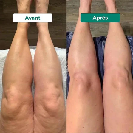 Résultat jambes avant après