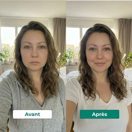 Résultat visage avant après